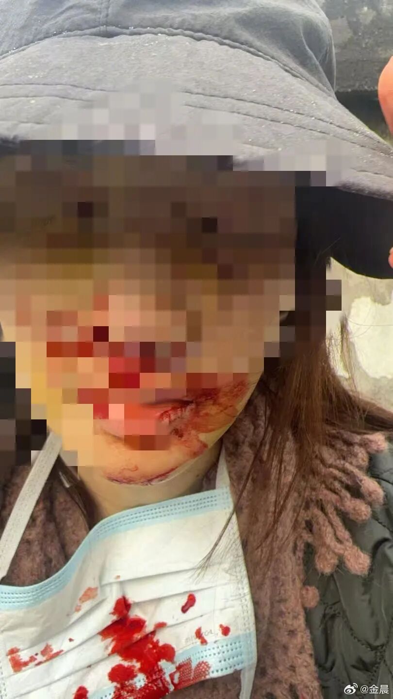 女演员金晨道歉！警方通报：金某驾车为避让犬只发生事故，脸部受伤急于就医打车离开，助理徐某青谎称自己是驾驶员，不存在骗保事实